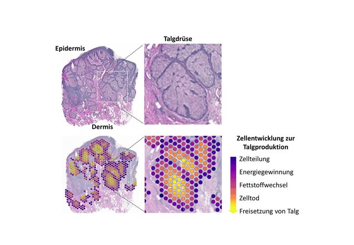 Darstellung der Differenzierung der Talgdrüsenzellen anhand von räumlicher Transkriptomuntersuchung. Obere Zeile: Histologische Struktur der untersuchten Talgdrüsen (Hämatoxylin-Eosin-Färbung). Der Bereich im weißen Rechteck ist rechts vergrößert. Untere Zeile: Die aus der molekulabiologischen und bioinformatischen Analyse generierten Cluster (bunte Kreise; links und Mitte) bilden die spezifische Genexpression in diesem Bereich ab. Sie wurden auf dem Originalgewebe übertragen und stellen die kontinuierliche Entwicklung der Talgdrüsenzellen durch konsekutive Modulation zellulärer Funktionen dar (rechts).